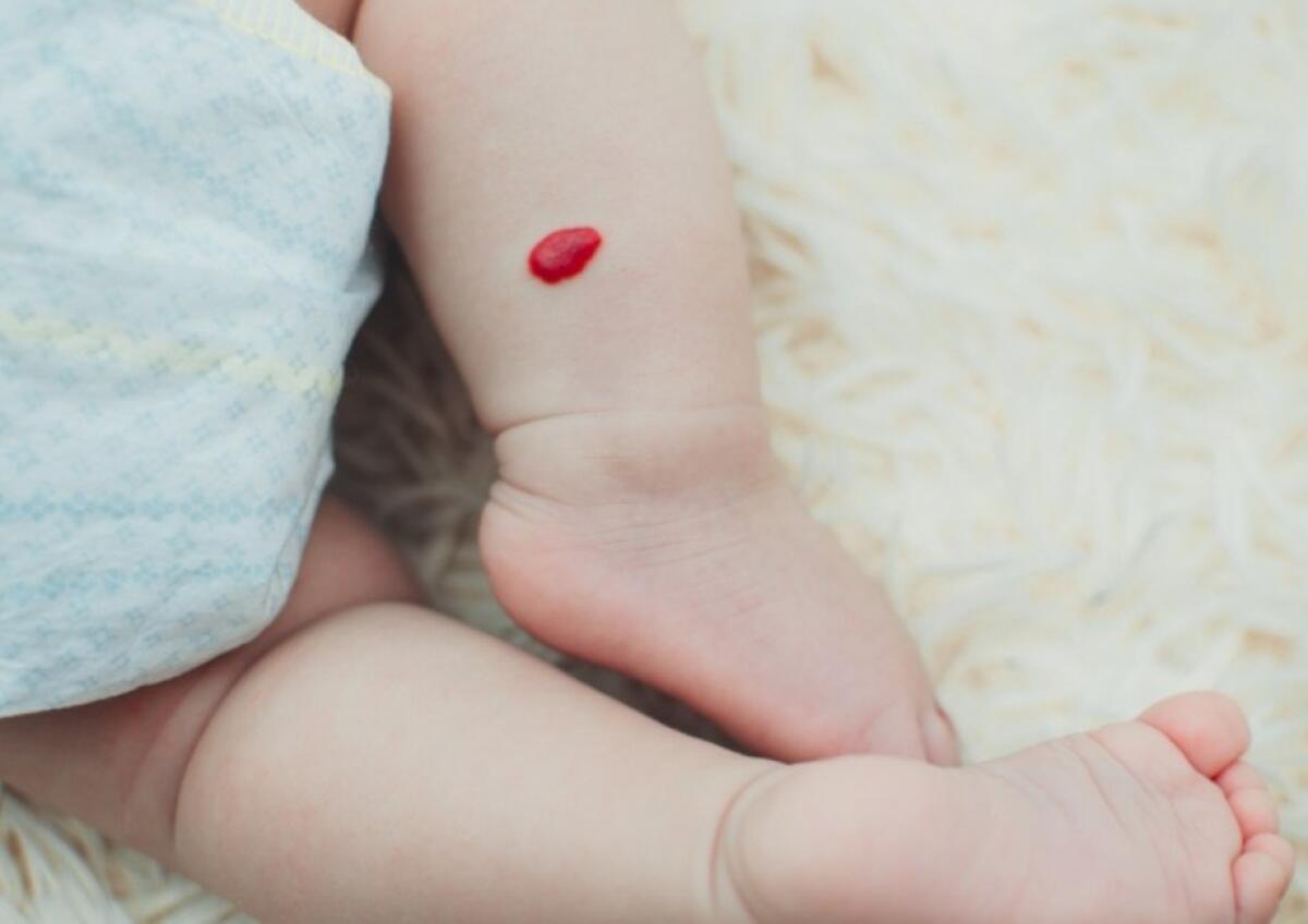 Emangioma o Angioma Infantile: Scopriamo la differenza - 