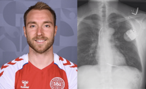 Christian Eriksen, con il dispositivo ICD