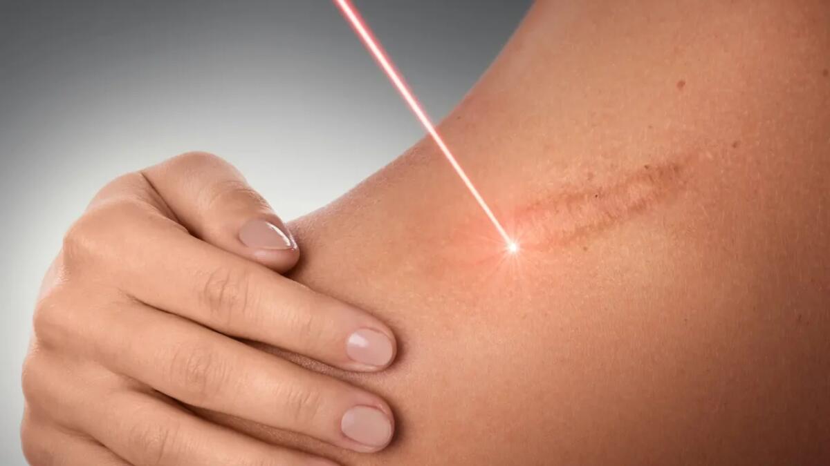 Penne laser portatili: ecco come trasformeranno il modo con cui trattiamo le ferite - 