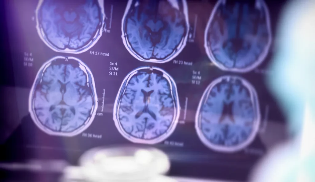 Terapia innovativa rinnova le cellule cerebrali e apre speranze per l’Alzheimer