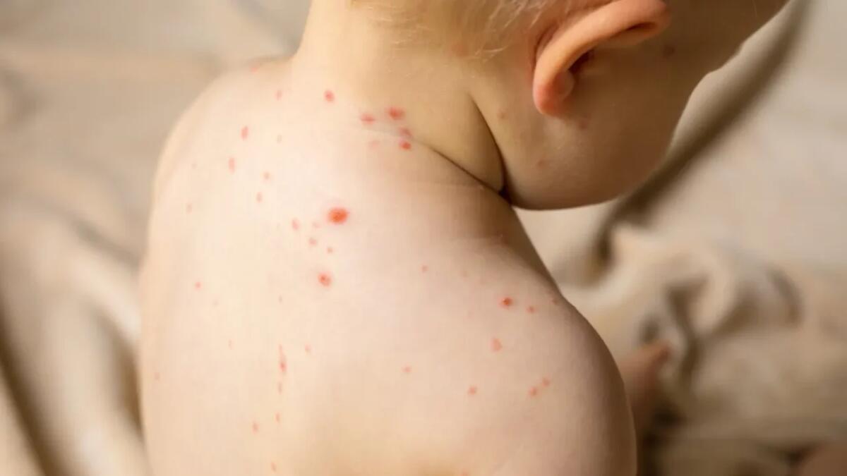 Il pericolo nascosto del morbillo: un virus letale che si annida nel cervello - 