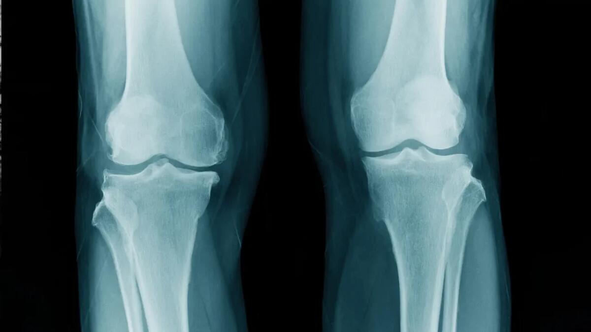 Guadagnare centimetri a caro prezzo: dentro la chirurgia per aumentare l’altezza - 